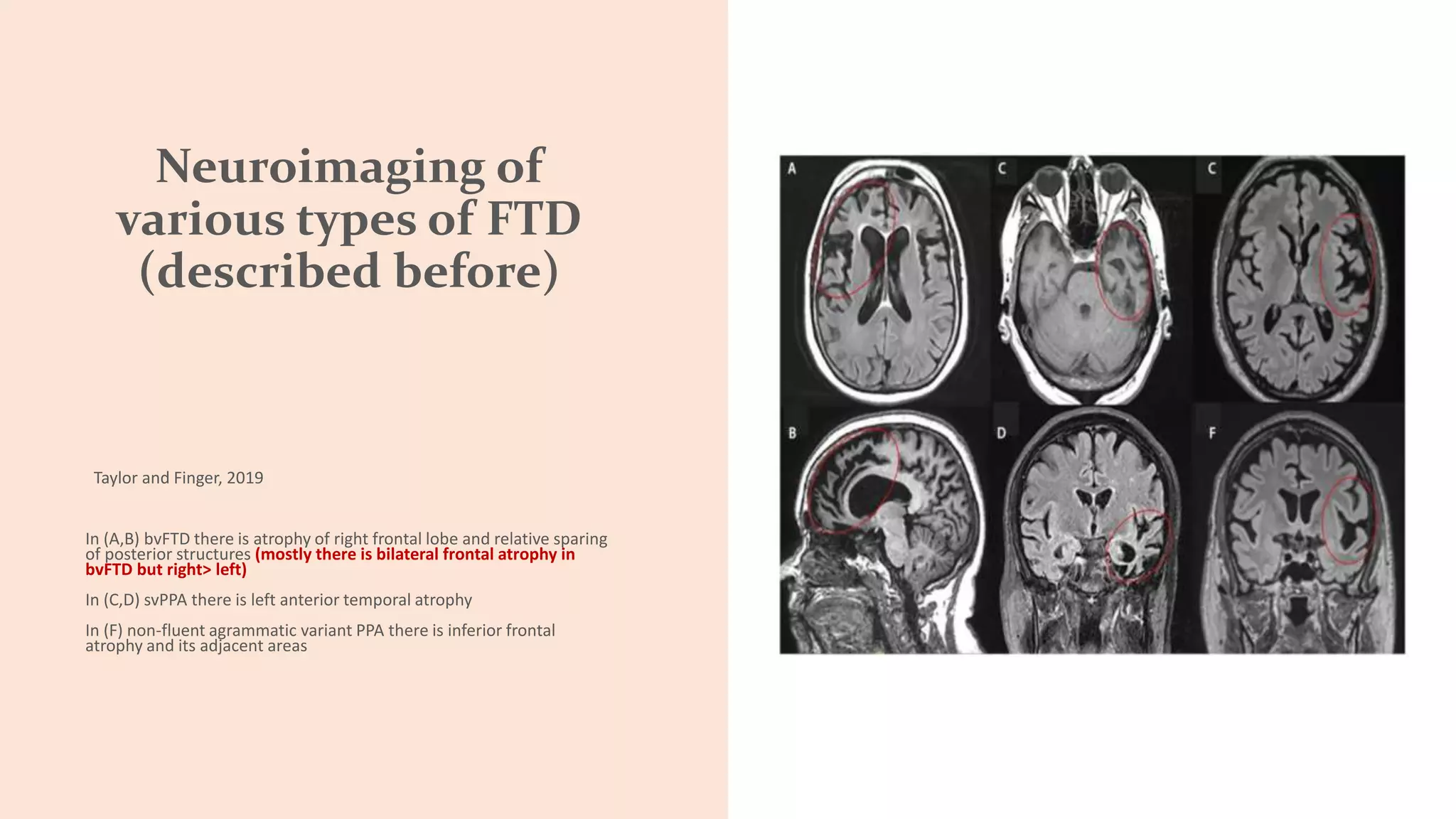 Neuroimaging of
various types of FTD
(described before)
Taylor and Finger, 2019
In (A,B) bvFTD there is atrophy of right frontal lobe and relative sparing
of posterior structures (mostly there is bilateral frontal atrophy in
bvFTD but right> left)
In (C,D) svPPA there is left anterior temporal atrophy
In (F) non-fluent agrammatic variant PPA there is inferior frontal
atrophy and its adjacent areas
 