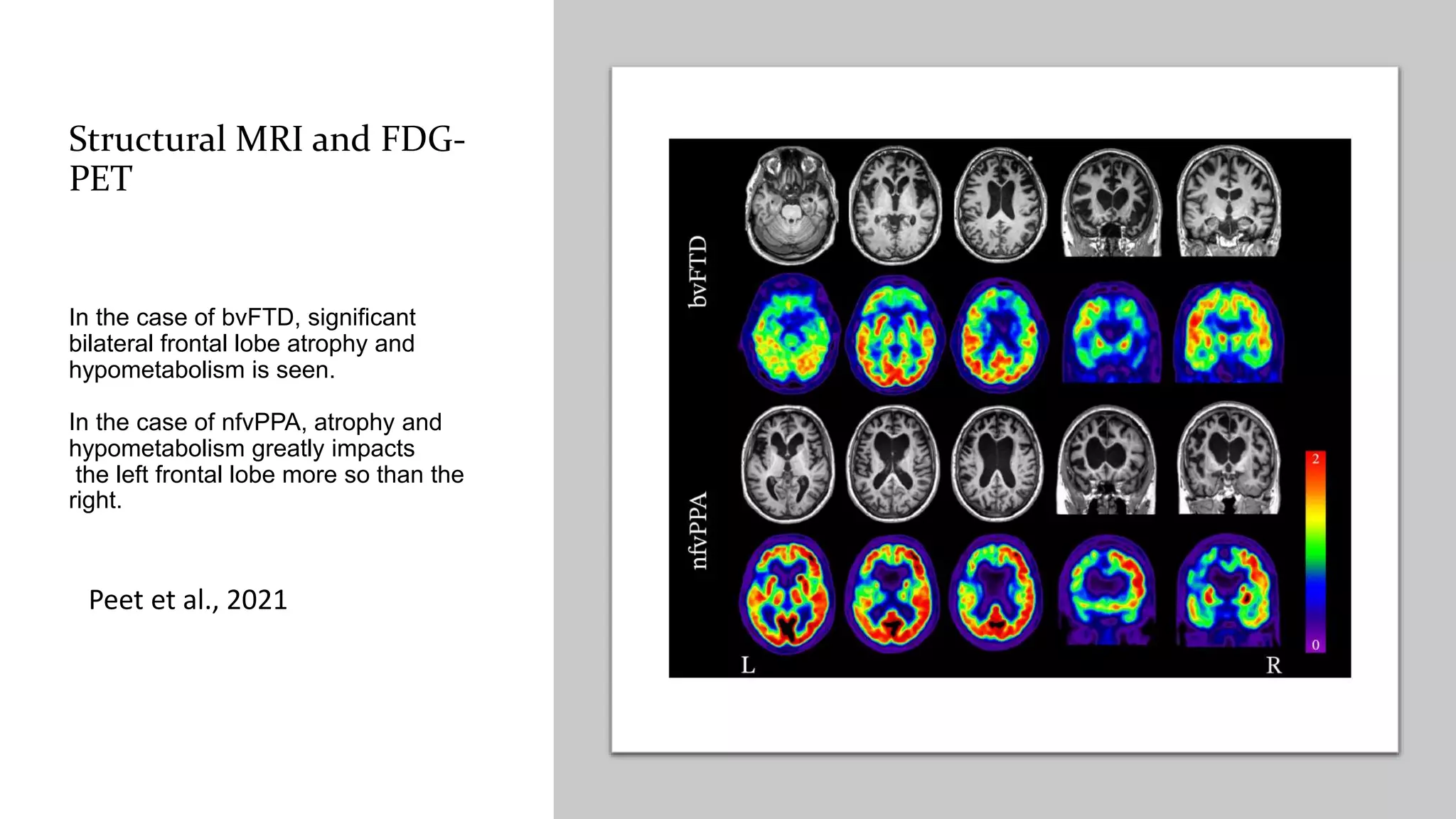 Structural MRI and FDG-
PET
In the case of bvFTD, significant
bilateral frontal lobe atrophy and
hypometabolism is seen.
In the case of nfvPPA, atrophy and
hypometabolism greatly impacts
the left frontal lobe more so than the
right.
Peet et al., 2021
 