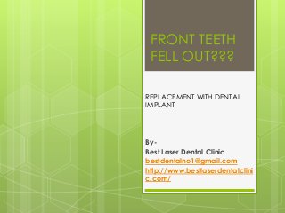FRONT TEETH
FELL OUT???
By-
Best Laser Dental Clinic
bestdentalno1@gmail.com
http://www.bestlaserdentalclini
c.com/
REPLACEMENT WITH DENTAL
IMPLANT
 