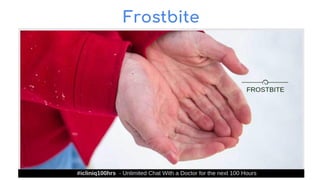 Frostbite