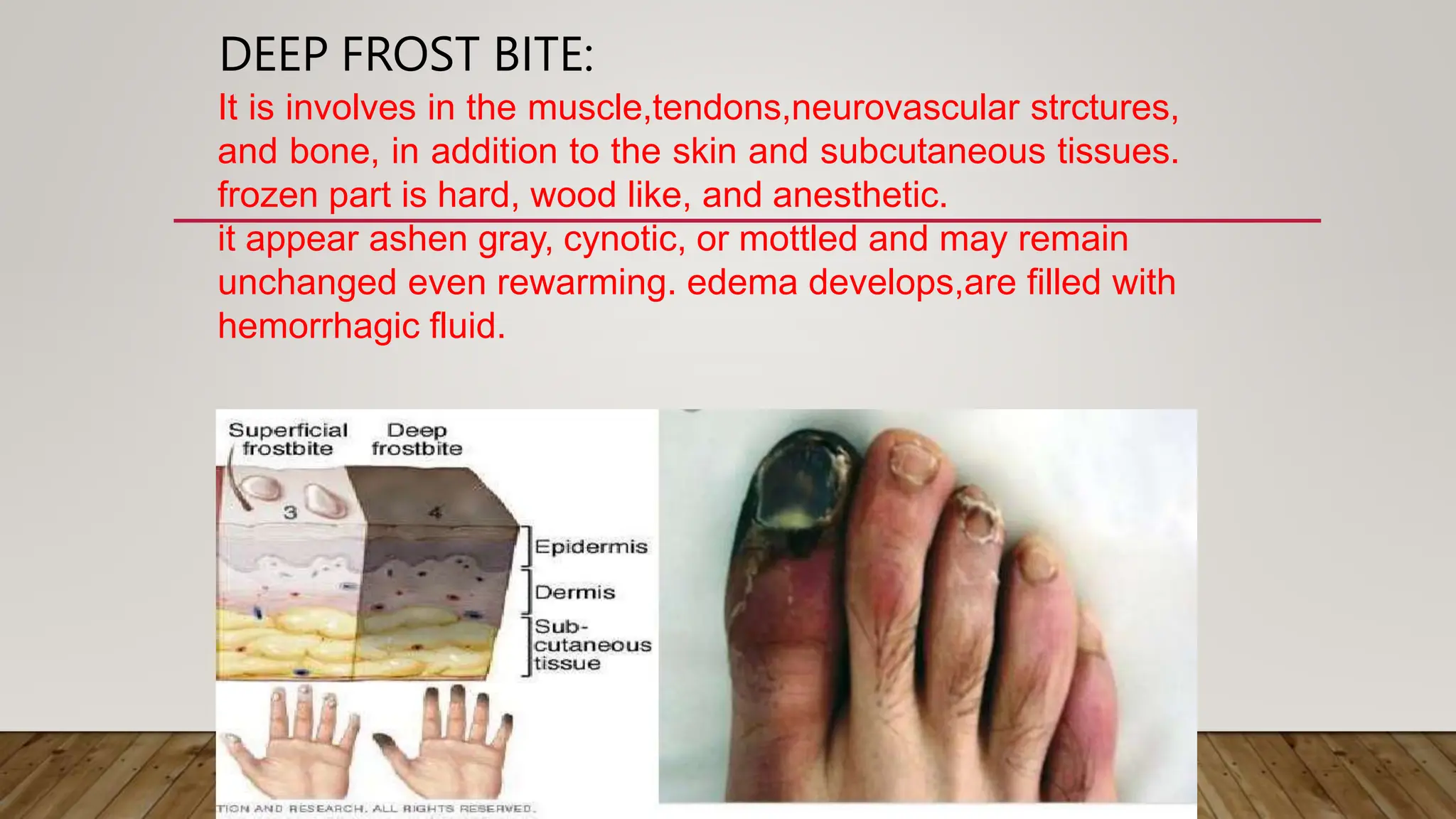 DEEP FROST BITE:
It is involves in the muscle,tendons,neurovascular strctures,
and bone, in addition to the skin and subcutaneous tissues.
frozen part is hard, wood like, and anesthetic.
it appear ashen gray, cynotic, or mottled and may remain
unchanged even rewarming. edema develops,are filled with
hemorrhagic fluid.
 