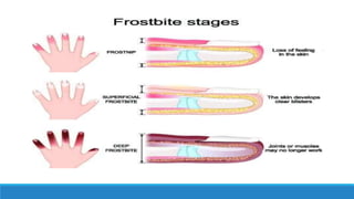 Frostbite Examples FROST BITE.pptx