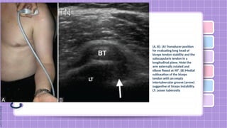 Lt Stability Hand Frozen shoulder- ika, nur, lov, zul, ita 281024.pptx