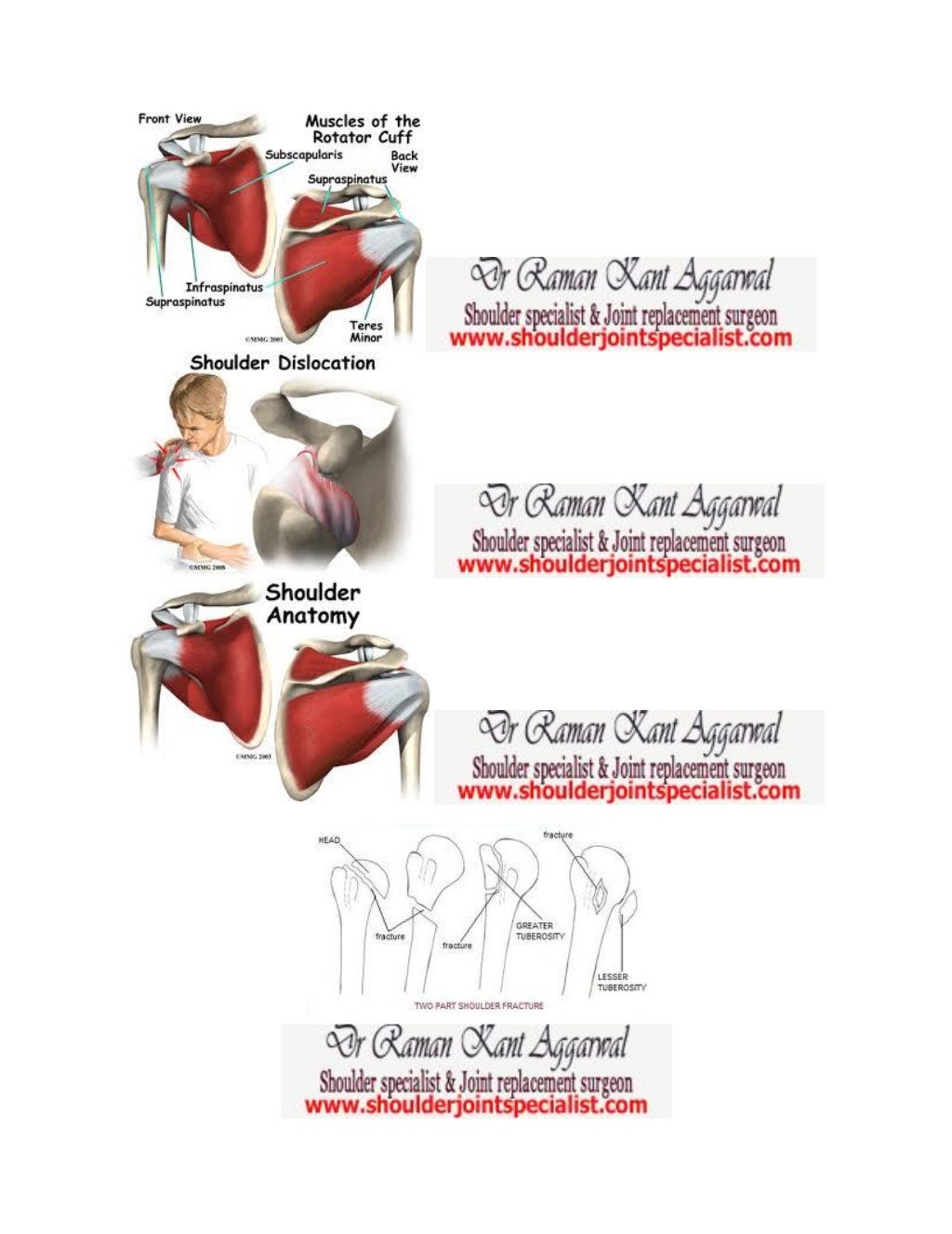 Frozen shoulder treatment shoulderjointspecialistsnappingscapula