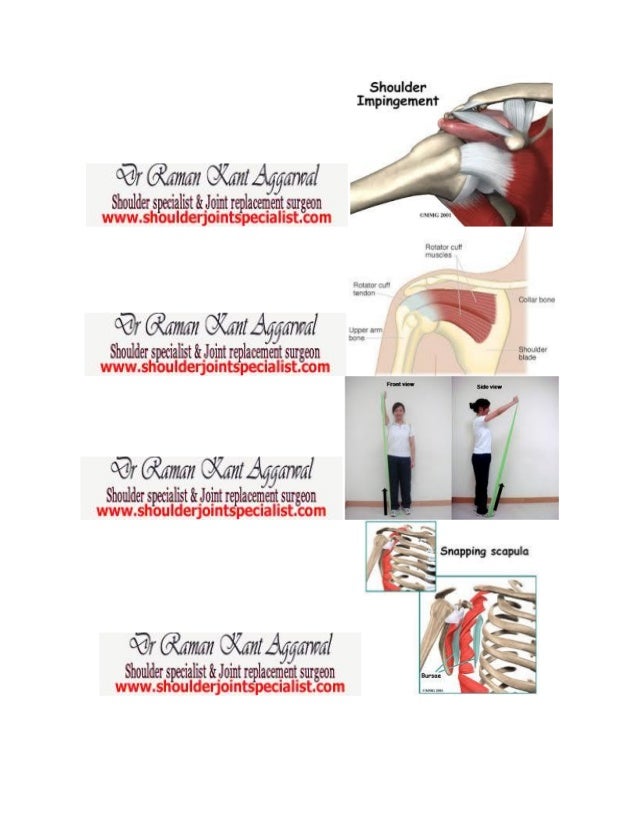 Frozen shoulder treatment shoulderjointspecialistsnappingscapula