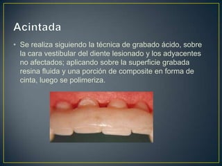 • Se realiza siguiendo la técnica de grabado ácido, sobre
  la cara vestibular del diente lesionado y los adyacentes
  no afectados; aplicando sobre la superficie grabada
  resina fluida y una porción de composite en forma de
  cinta, luego se polimeriza.
 