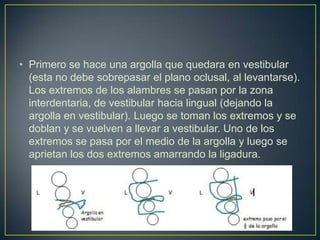 • Primero se hace una argolla que quedara en vestibular
  (esta no debe sobrepasar el plano oclusal, al levantarse).
  Los extremos de los alambres se pasan por la zona
  interdentaria, de vestibular hacia lingual (dejando la
  argolla en vestibular). Luego se toman los extremos y se
  doblan y se vuelven a llevar a vestibular. Uno de los
  extremos se pasa por el medio de la argolla y luego se
  aprietan los dos extremos amarrando la ligadura.
 