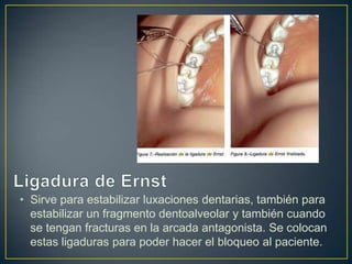 • Sirve para estabilizar luxaciones dentarias, también para
  estabilizar un fragmento dentoalveolar y también cuando
  se tengan fracturas en la arcada antagonista. Se colocan
  estas ligaduras para poder hacer el bloqueo al paciente.
 