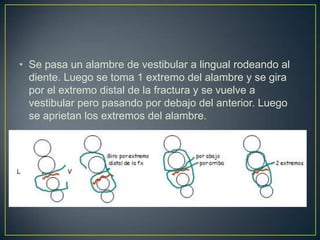 • Se pasa un alambre de vestibular a lingual rodeando al
  diente. Luego se toma 1 extremo del alambre y se gira
  por el extremo distal de la fractura y se vuelve a
  vestibular pero pasando por debajo del anterior. Luego
  se aprietan los extremos del alambre.
 