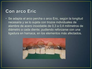 • Se adapta el arco percha o arco Eric, según la longitud
  necesaria y se lo sujeta con trozos individuales de
  alambre de acero inoxidable de 0,3 a 0,4 milímetros de
  diámetro a cada diente; pudiendo reforzarse con una
  ligadura en hamaca, en los elementos más afectados.
 