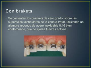 • Se cementan los brackets de cero grado, sobre las
  superficies vestibulares de la zona a tratar, utilizando un
  alambre redondo de acero inoxidable 0,16 bien
  contorneado, que no ejerza fuerzas activas.
 