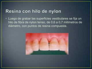 • Luego de grabar las superficies vestibulares se fija un
  hilo de fibra de nylon tenso, de 0,6 a 0,7 milímetros de
  diámetro, con puntos de resina compuesta.
 