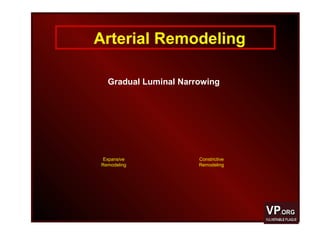 Arterial Remodeling
Gradual Luminal Narrowing
Expansive
Remodeling
Constrictive
Remodeling
 