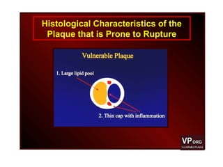 Histological Characteristics of the
Plaque that is Prone to Rupture
 