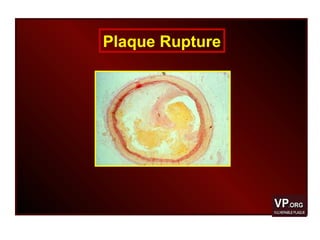 Plaque Rupture
 