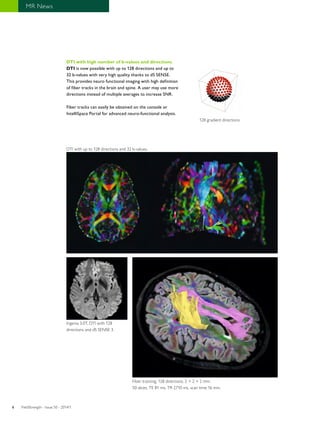 6 MR News 
DTI with high number of b-values and directions 
DTI is now possible with up to 128 directions and up to 
32 b-values with very high quality thanks to dS SENSE. 
This provides neuro functional imaging with high definition 
of fiber tracks in the brain and spine. A user may use more 
directions instead of multiple averages to increase SNR. 
Fiber tracks can easily be obtained on the console or 
IntelliSpace Portal for advanced neuro-functional analysis. 
DTI with up to 128 directions and 32 b-values. 
Ingenia 3.0T, DTI with 128 
directions and dS SENSE 3. 
128 gradient directions 
Fiber tracking, 128 directions, 2 × 2 × 2 mm. 
50 slices, TE 81 ms, TR 2710 ms, scan time 16 min. 
FieldStrength - I 6 ssue 50 - 2014/1 
 