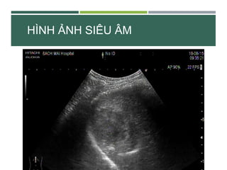 HÌNH ẢNH SIÊU ÂM
 