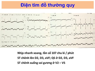 Điện tim đồ thường quy
Nhịp nhanh xoang, tần số 107 chu kì / phút
ST chênh lên D2, D3, aVF; QS ở D2, D3, aVF
ST chênh xuốn...