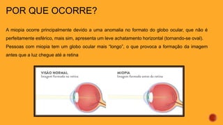POR QUE OCORRE?
A miopia ocorre principalmente devido a uma anomalia no formato do globo ocular, que não é
perfeitamente esférico, mais sim, apresenta um leve achatamento horizontal (tornando-se oval).
Pessoas com miopia tem um globo ocular mais “longo”, o que provoca a formação da imagem
antes que a luz chegue até a retina
 