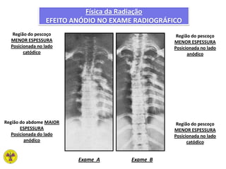 Física da Radiação
EFEITO ANÓDIO NO EXAME RADIOGRÁFICO
Região do pescoço
MENOR ESPESSURA
Posicionada no lado
catódico
Região do abdome MAIOR
ESPESSURA
Posicionada do lado
anódico
Região do pescoço
MENOR ESPESSURA
Posicionada no lado
anódico
Região do pescoço
MENOR ESPESSURA
Posicionada no lado
catódico
Exame A Exame B
 
