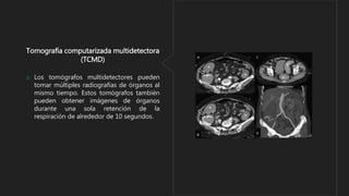 Tomografía computarizada multidetectora
(TCMD)
o Los tomógrafos multidetectores pueden
tomar múltiples radiografías de órganos al
mismo tiempo. Estos tomógrafos también
pueden obtener imágenes de órganos
durante una sola retención de la
respiración de alrededor de 10 segundos.
 