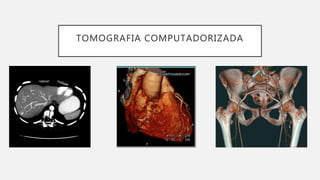 TOMOGRAFIA COMPUTADORIZADA
 