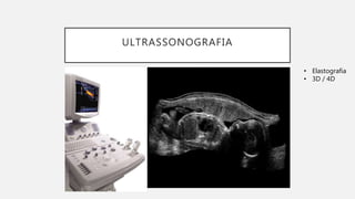 ULTRASSONOGRAFIA
• Elastografia
• 3D / 4D
 