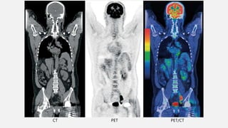 CT PET PET/CT
 