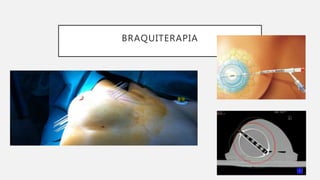 BRAQUITERAPIA
 