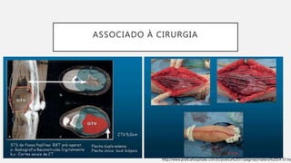ASSOCIADO À CIRURGIA
http://www.praticahospitalar.com.br/pratica%2037/paginas/materia%2014-37.htm
 