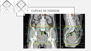 CURVAS DE ISODOSE
 
