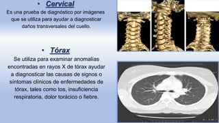• Cervical
Es una prueba de diagnóstico por imágenes
que se utiliza para ayudar a diagnosticar
daños transversales del cuello.
• Tórax
Se utiliza para examinar anomalías
encontradas en rayos X de tórax ayudar
a diagnosticar las causas de signos o
síntomas clínicos de enfermedades de
tórax, tales como tos, insuficiencia
respiratoria, dolor torácico o fiebre.
 