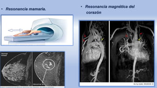 • Resonancia mamaria.
• Resonancia magnética del
corazón
 