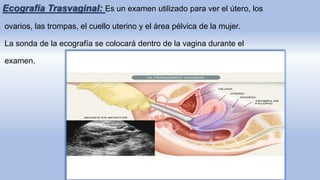Ecografía Trasvaginal: Es un examen utilizado para ver el útero, los
ovarios, las trompas, el cuello uterino y el área pélvica de la mujer.
La sonda de la ecografía se colocará dentro de la vagina durante el
examen.
 