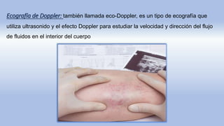 Ecografía de Doppler: también llamada eco-Doppler, es un tipo de ecografía que
utiliza ultrasonido y el efecto Doppler para estudiar la velocidad y dirección del flujo
de fluidos en el interior del cuerpo
 