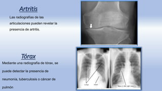 Artritis
Las radiografías de las
articulaciones pueden revelar la
presencia de artritis.
Mediante una radiografía de tórax, se
puede detectar la presencia de
neumonía, tuberculosis o cáncer de
pulmón
Tórax
 