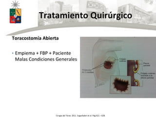  	
  	
  	
  	
  	
  	
  Tratamiento	
  Quirúrgico	
  
	
  
Cirugía	
  del	
  Tórax.	
  2011.	
  Sugarbaker	
  et	
  al.	
  Pág	
  621	
  –	
  628.	
  
Toracostomía	
  Abierta	
  
	
  
•  Empiema	
  +	
  FBP	
  +	
  Paciente	
  
Malas	
  Condiciones	
  Generales	
  
	
  
	
  
 