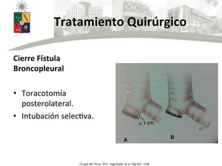  	
  	
  	
  	
  	
  Tratamiento	
  Quirúrgico	
  
Cierre	
  Fístula	
  
Broncopleural	
  
	
  
•  Toracotomía	
  
posterolateral.	
  
•  Intubación	
  selecUva.	
  
Cirugía	
  del	
  Tórax.	
  2011.	
  Sugarbaker	
  et	
  al.	
  Pág	
  621	
  –	
  628.	
  
 