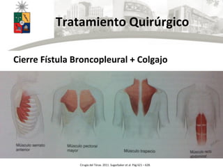  	
  	
  	
  	
  	
  	
  Tratamiento	
  Quirúrgico	
  
Cierre	
  Fístula	
  Broncopleural	
  +	
  Colgajo	
  
	
  
Cirugía	
  del	
  Tórax.	
  2011.	
  Sugarbaker	
  et	
  al.	
  Pág	
  621	
  –	
  628.	
  
 