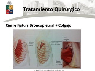  	
  	
  	
  	
  	
  Tratamiento	
  Quirúrgico	
  
Cierre	
  Fístula	
  Broncopleural	
  +	
  Colgajo	
  
Cirugía	
  del	
  Tórax.	
  2011.	
  Sugarbaker	
  et	
  al.	
  Pág	
  621	
  –	
  628.	
  
 