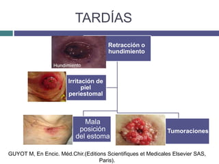 Retracción o
hundimiento
Mala
posición
del estoma
Tumoraciones
Irritación de
piel
periestomal
TARDÍAS
GUYOT M, En Encic. Méd.Chir.(Editions Scientifiques et Medicales Elsevier SAS,
Paris).
 