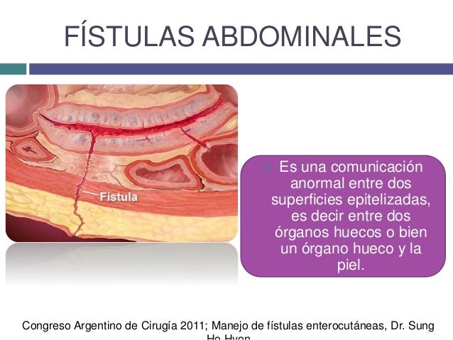 Abdominal Fistula Surgery