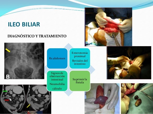 Fistula biliar postcolecistectom a