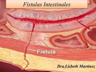 Fístulas Intestinales
Dra.Lisbeth Martínez
 