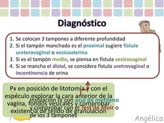 Diagnóstico 
1. Se colocan 3 tampones a diferente profundidad 
2. Si el tampón manchado es el proximal sugiere fístula 
ureterovaginal o vesicouterina 
3. Si es el Exploración tampón medio, física: 
se piensa en fístula vesicovaginal 
4. Si se mancha el distal, se considera fístula uretrovaginal o 
incontinencia de orina 
Px en posición de litotomía y con el 
espéculo explorar la cara anterior de la 
vagina, fondos vesicales y comprobar 
existencia de tejido de granulación 
Angélica 
Instilación IV con azul de metileno 
y comprobar con el Test de Moir o 
de los 3 tampones 
 
