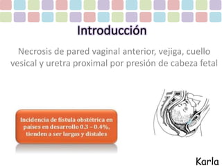 Introducción 
Necrosis de pared vaginal anterior, vejiga, cuello 
vesical y uretra proximal por presión de cabeza fetal 
Karla 
 