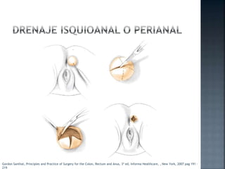 Gordon Santhat, Principles and Practice of Surgery for the Colon, Rectum and Anus, 3ª ed, Informa Healthcare, , New York, 2007 pag 191 -
219
 