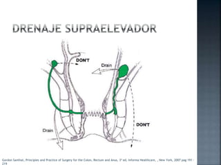 Gordon Santhat, Principles and Practice of Surgery for the Colon, Rectum and Anus, 3ª ed, Informa Healthcare, , New York, 2007 pag 191 -
219
 