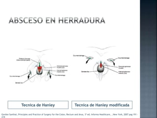 Tecnica de Hanley Tecnica de Hanley modificada
Gordon Santhat, Principles and Practice of Surgery for the Colon, Rectum and Anus, 3ª ed, Informa Healthcare, , New York, 2007 pag 191 -
219
 
