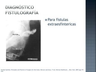  Para fistulas
extraesfintericas
Gordon Santhat, Principles and Practice of Surgery for the Colon, Rectum and Anus, 3ª ed, Informa Healthcare, , New York, 2007 pag 191 -
219
 